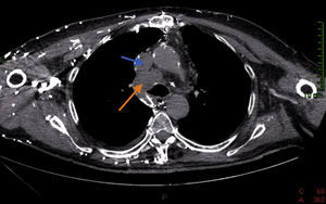 Tomografía computarizada con contraste intravenoso de tórax. Conglomerado de adenopatías (flecha naranja) que se sitúan posteriormente a la vena cava superior (flecha azul), infiltrándola por completo.