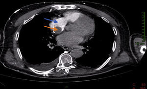 Tomografía computarizada con contraste intravenoso de tórax. Defecto de repleción que se corresponde con masa tumoral (flecha naranja) en el interior de la aurícula derecha (flecha azul).
