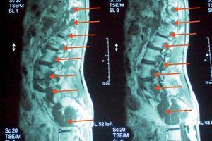 Resonancia magnética nuclear de columna dorso-lumbo-sacra. Se aprecian múltiples lesiones dependientes de las raíces bilaterales que condicionan el agrandamiento generalizado de los desfiladeros radiculares y de los orificios de conjunción (flechas).