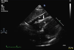 Ecocardiografía transtorácica, ventana subcostal, en la que se visualiza el derrame pericárdico (DP) y se observa cómo durante la diástole precoz se colapsa (flecha) la pared libre del ventrículo derecho (VD).