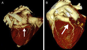 A. Precirugía: se observa la arteria cincunfleja drenando en la aurícula derecha. B. Poscirugía: se aprecia la obliteración de la fístula de la arteria cincunfleja.