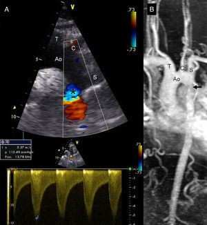 A) Aceleración diastólica del doppler color a nivel de la coartación en ecocardiografía transtorácica (plano supraesternal). Registro de dopler espectral continuo con gradiente sistólico máximo de 115mmHg y extensión diastólica. B)Coartación (flecha) en reconstrucción de aorta y grandes vasos mediante resonancia magnética. Ao: cayado aórtico; C: arteria carótida izquierda; S: arteria subclavia izquierda; T: tronco braquiocefálico.