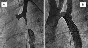 A)Aortografías simultáneas (proyección oblicua-izquierda) en segmentos proximal y distal de un paciente con interrupción del arco aórtico. B)Aortografía en la misma proyección tras la recanalización y el implante de un stent cubierto.