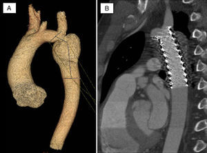 A)Imagen TAC-64 de la aorta de un paciente con recoartación y aneurisma post-cirugía. B)Imagen TAC-64 de la aorta en el seguimiento, tras el implante de un stent cubierto diseñado a medida. Obsérvese la completa obliteración del aneurisma.