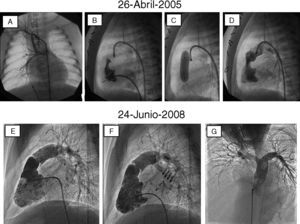Evolución del corazón derecho en un paciente con atresia pulmonar con septo íntegro que inicialmente requirió fístula sistémico-pulmonar de Blalock-Taussig (A) que resultó insuficiente, por lo que se procedió a la apertura de la membrana atrésica (B-D). Al cabo de casi 3años, el ventrículo derecho, que era hipoplásico, mostró un desarrollo adecuado en tamaño y función, lo que permitió el cierre de la comunicación interauricular con dispositivo de Amplatz (flechas) (E y F). La angiografía en arteria pulmonar (G) mostró también un adecuado desarrollo del sexto arco con competencia adecuada del remanente valvular.
