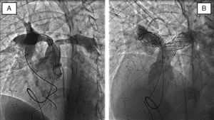 Arteriografías en arteria pulmonar (proyección de 4cámaras) en un paciente con estenosis de ramas en ambos orígenes, antes (A) y después (B) del implante de stents.