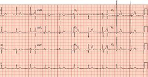 Electrocardiograma de paciente hipertenso en el que se muestra ritmo sinusal a 62latidos/min y crecimiento ventricular izquierdo por voltaje (índice de Sokolow-Lyon>35mm), sin otros hallazgos relevantes.
