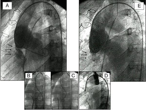 Fístula posquirúrgica entre el seno de Valsalva y el ventrículo derecho. A)Aortografía basal (proyección oblicuo-izquierda) que muestra el chorro de la fístula (flechas). B,C)Creación de un circuito veno-arterial con captura de una guía. D)Posicionamiento del dispositivo de Amplatz. E)Aortografía postimplante con cierre completo de la fístula por el dispositivo (flechas).