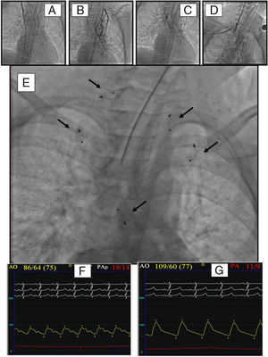 Implante de múltiples oclusores vasculares en múltiples fístulas arteriovenosas pulmonares en un paciente con intervención de Glenn que va a ser intervenido de Fontan. A-D)Inyecciones angiográficas en las fístulas. E)Imagen radiológica del tórax tras el implante de los oclusores (flechas). F,G)Se muestran los cambios observados en el registro de presiones simultáneas en la aorta y la arteria pulmonar. La caída de esta y el aumento de la presión sistémica van a permitir la intervención de Fontan.