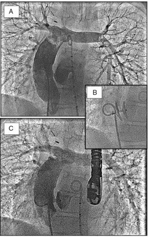 Cierre percutáneo de fenestración de Fontan con dispositivo de Amplatz (foramen). A)Angiografía antes. B)Dispositivo implantado. C)Angiografía postimplante.