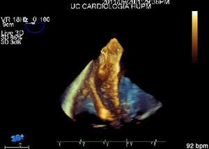 Imagen de ecocardiografía transesofágica de Eco 3D en la que se visualiza el dispositivo Amplatzer® CIV muscular PI de 18mm.