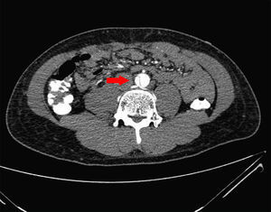 La angioTAC de aorta abdominal muestra la presencia de una disección que se extiende hasta justo antes de la salida de las arterías ilíacas.