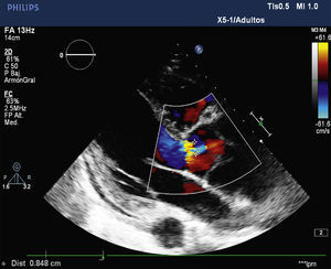 El plano paraesternal del eje largo (ETT) muestra una marcada dilatación aneurismática de la aorta ascendente con imagen de flap intimal a 6cm del anillo y jet de insuficiencia severa.