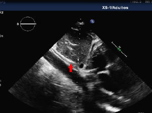 El plano subcostal permite visualizar una doble luz aórtica en la aorta abdominal proximal.