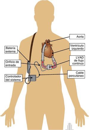 Descripción de la estructura, mecanismos y componentes de una bomba de flujo continuo para soporte del ventrículo izquierdo (LVAD).