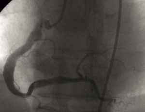 Coronariografía derecha (CD). Proyección posteroanterior. Se observa ectasia coronaria difusa en CD sin estenosis angiográficas.