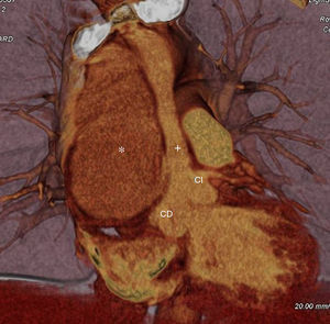 Reconstrucción 3D de tomografía computarizada que muestra el aneurisma de aorta ascendente con el flap intimal entre la falsa (*) y la verdadera (+) luz y ostium de coronaria derecha (CD) y coronaria izquierda (CI) con origen en la luz verdadera.