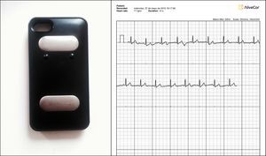 A la izquierda fotografía del dispositivo AliveCor, versión compatible con iPhone 4. A la derecha trazado en ritmo sinusal correspondiente a la derivación I del electrocardiograma convencional.