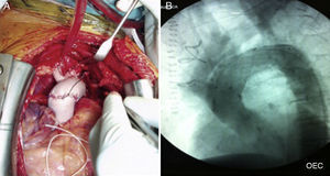 A) Sustitución de arco aórtico por cirugía abierta con tubo trifurcado. B) Imagen radiológica, tras un procedimiento híbrido con desramificación de los troncos supraaórticos y colocación de endoprótesis en arco.