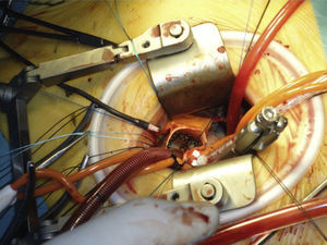 Visión del campo quirúrgico en una minitoracotomía anterior derecha a 2.° espacio intercostal derecho, con canulación anterógrada y válvula sin sutura Perceval implantada (H.U. Infanta Cristina, Badajoz).