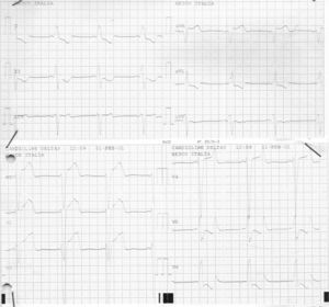 Electrocardiograma de un paciente afecto de miocardiopatía no compactada que muestra bloqueo de rama izquierda y alteraciones en la repolarización. Intervalo QT corregido de 511 ms.