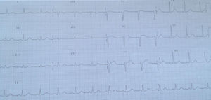 Electrocardiograma post-cateterismo.