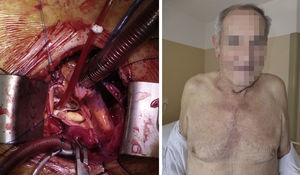A la izquierda, visión del campo quirúrgico en la miniesternotomía superior en J. A la derecha, resultado estético final en paciente octogenario.