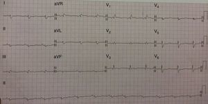 Electrocardiograma típico de un paciente con amiloidosis cardíaca mostrando bajos voltajes en las derivaciones de los miembros (QRS ≤ 0,5mV).