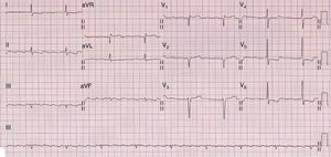 Otro ejemplo de electrocardiograma en la amiloidosis cardíaca, donde además de los bajos voltajes en las derivaciones de los miembros puede apreciarse un patrón de seudoinfarto anteroseptal.