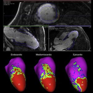 En la mitad superior se muestran imágenes de resonancia magnética con realce tardío de gadolinio obtenidas en un paciente con infarto anteroapical transmural. La resonancia ha sido segmentada y posprocesada con un software basado en la intensidad de señal de pixel. En la miad inferior se muestra una reconstrucción tridimensional y por capas (endocardio, mediomiocardio y epicardio) del ventrículo izquierdo en la que se ha codificado el miocardio en colores (sano en púrpura, cicatriz densa en rojo y tejido viable en verde-amarillo). Se consigue de este modo cuantificar la cicatriz (extensión) y caracterizarle en base a sus componentes (cicatriz densa vs. tejido viable o border zone).