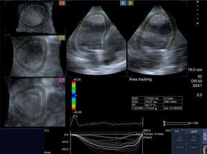 Imagen del area strain y función ventricular izquierda de un paciente con estenosis aórtica severa, procesada a través del programa informático del ecógrafo Artida®.