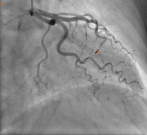 Disección en tercio medio-distal de la arteria descendente anterior (flecha) con flujo TIMI 0 y relleno pobre por colaterales de tercio distal.