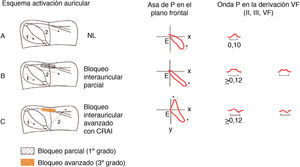 En la figura se puede ver la activación auricular en caso anormal (A), bloqueo interauricular parcial (B) y avanzado (C).