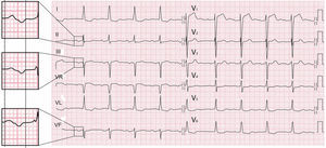 ECG típico de bloqueo avanzado interauricular (P± en II, III y VF con una duración >120 ms) en un paciente con cardiopatía isquémica. En la imagen ampliada se puede ver el comienzo de P en las 3derivaciones.