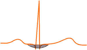Véase la onda de repolarización auricular normalmente enmascarada por el QRS.