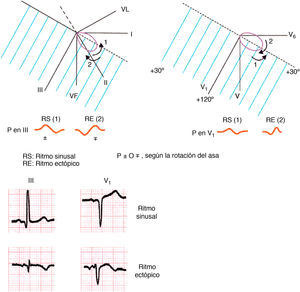 Según la rotación del asa (antihoraria en los planos frontal y horizontal en caso de ritmo sinusal, y horaria en caso de ritmo ectópico), la morfología de la onda P en III y V1 varía.