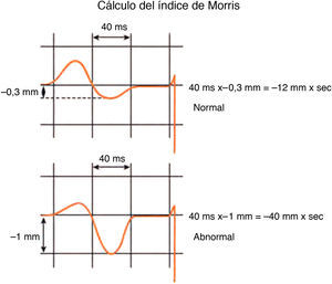 Obsérvese como se calcula el índice de Morris. Mirando la duración del modo negativo de la P en V1 (anormal si es ≥ 40ms de duración y ≥ 1mm de profundidad.