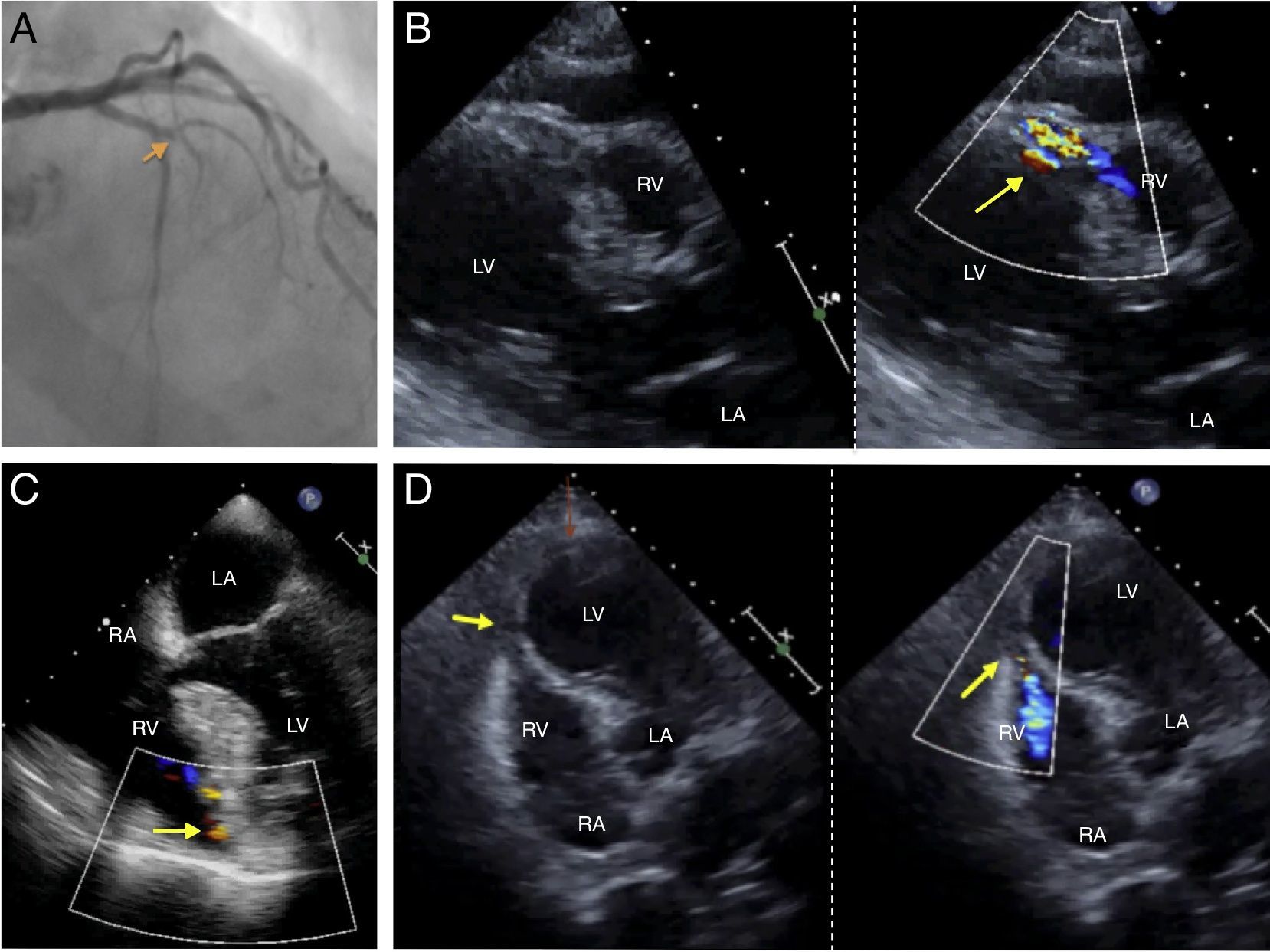 Ventricular septal rupture after acute myocardial infarction | Cardiocore