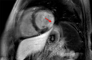 RMN cardíaca con gadolinio en secuencia de realce tardío. Hipertrofia septal ligera. Escara isquémica posterolateral (flecha).