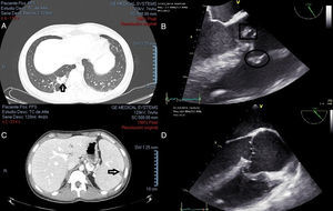 Embolización séptica paradójica en lóbulo pulmonar inferior derecho (A, flecha). Vegetación cara ventricular de velo no coronariano de válvula aórtica (B, cuadro). Vegetación en orificio de CIV (B, círculo). Infarto esplénico cortical y esplenomegalia (C, flecha). Ausencia de vegetaciones (D).