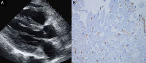A: ecocardiografía transtorácica: hipertrofia severa concéntrica de ambos ventrículos. B: inmunotinción endotelial y endocárdica evidente para C4d.