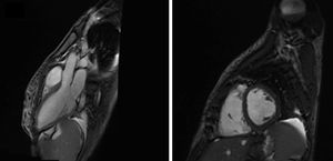 Cardiac magnetic resonance imaging (MRI) confirmed biventricular systolic dysfunction but no abnormalities in delayed myocardial enhancement were detected.