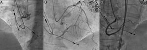 Imagen correspondiente a oclusión crónica de arteria coronaria derecha. En la imagen (A) se visualiza la oclusión tras la inyección anterógrada. En la imagen (B) podemos ver el relleno distal por heterocolaterales de ramas septales. Finalmente, en la imagen (C) se visualiza el resultado angiográfico tras el procedimiento percutáneo.