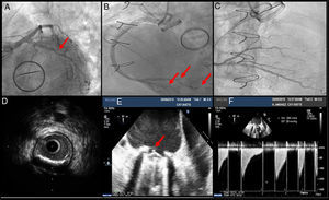 Coronariografía que muestra: A) Arteria circunfleja (ACx) de buen desarrollo con placa ligera. Se puede apreciar hemidisco protésico mitral fijo. B) Imagen de múltiples embolismos en la interventricular posterior y tronco posterolateral. C) Progresión de IVUS hasta oclusión trombótica en tronco posterolateral. D) IVUS de tronco posterolateral con placa arteriosclerótica calcificada no complicada. E) Ecocardiografía transesofágica con hemidisco posterolateral mitral fijo y restos de trombo adherido. F) Imagen de gradientes transmitrales elevados sugestivos de trombosis protésica mitral.