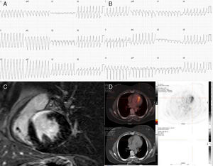 A) TV1: TV con longitud de ciclo de 290ms, morfología de bloqueo de rama izquierda (QRS 180ms), eje inferior derecho y disociación VA. B) TV2: TV con longitud de ciclo de 280ms, morfología de bloqueo de rama izquierda (QRS 120ms), eje superior izquierdo y disociación VA. C) Secuencias de realce tardío con gadolinio en la CRM. D) Hipercaptación con 18F-FDG de PET/TC toracoabdominal.