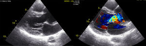 Dilatación de la raíz aórtica junto con la insuficiencia aórtica severa y flap intimal en la aorta descendente.