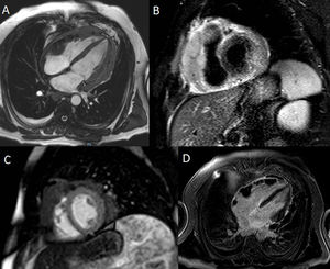 A. Secuencia en sangre blanca, 4 cámaras donde se aprecian masas pericárdicas confluyentes e infiltrantes en pared lateral de VD y anillo tricuspídeo con señal intermedia en T1. B. Secuencia en T2-STIR, eje corto donde se aprecian masas pericárdicas en señal intermedia-baja en T2 y ligero derrame pericárdico. C. Secuencia de perfusión en reposo en eje corto objetivando perfusión no homogénea de las masas pericárdicas con focos necróticos o de baja captación. D. Secuencia de realce tardío en 4 cámaras con masas con ausencia de focos de fibrosis.