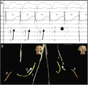A) Electrogramas intracavitarios mostrando His situado en ventrículo derecho y seno coronario de proximal (9-10) a distal (1-2). Mediante estimulación ventricular a 500ms se observa conducción retrógrada a través de la vía accesoria con mayor precocidad en seno coronario distal, que desaparece durante la ablación con disociación ventrículo-atrial (asterisco). B) Visión LAO y RAO en sistema EnSite® NavX® (St Jude Medical, Tex. EE. UU.). En el n.° 1, catéter de seno coronario. N.° 2, catéter situado en His. En n.° 3, catéter de ablación, con punto ablación en región lateral izquierda del anillo mitral.