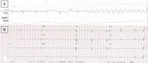 1A Electrocardiograma (ECG) durante síntomas con inicio de la TVS helicoidal a 250lpm. 1B ECG posterior al episodio con ritmo sinusal a 60lpm y QTc de 570mseg.