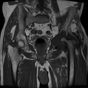 MR. Coronal T1-weighted sequence showing extensive erosions in the acetabular cavity and destruction of the head of the femur accompanied by extensive articular effusion.